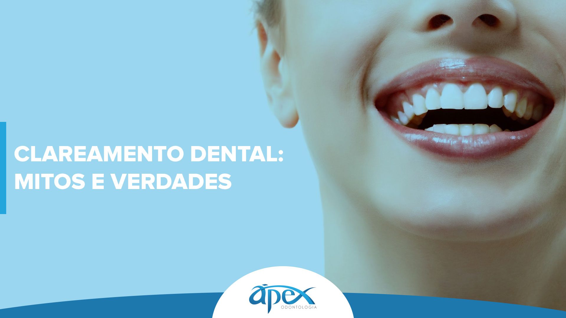 Clareamento Dental: Mitos E Verdades