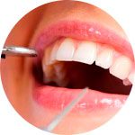 Limpeza Bucal | Apex Odontologia