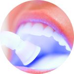 Sessão de Clareamento | Apex Odontologia