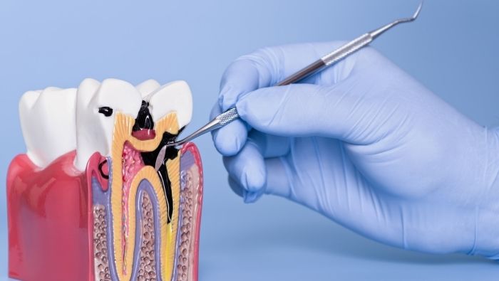 Modelo anatômico de dente com cárie sendo manipulado por instrumento odontológico.